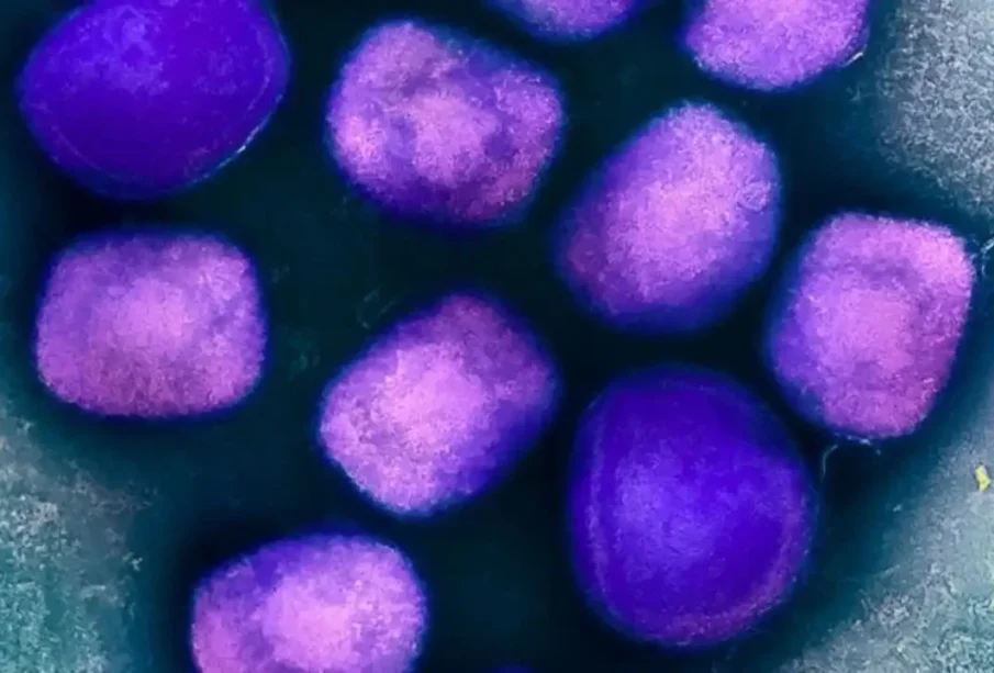 خیبرپختونخوا : رواں برس کا پہلا منکی پاکس کیس رپورٹ