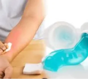 جلی ہوئی جلد پر ٹوتھ پیسٹ لگانےکےخطرناک اثرات