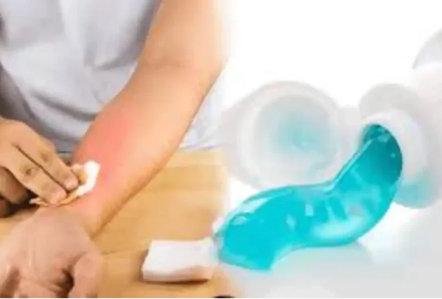 جلی ہوئی جلد پر ٹوتھ پیسٹ لگانےکےخطرناک اثرات