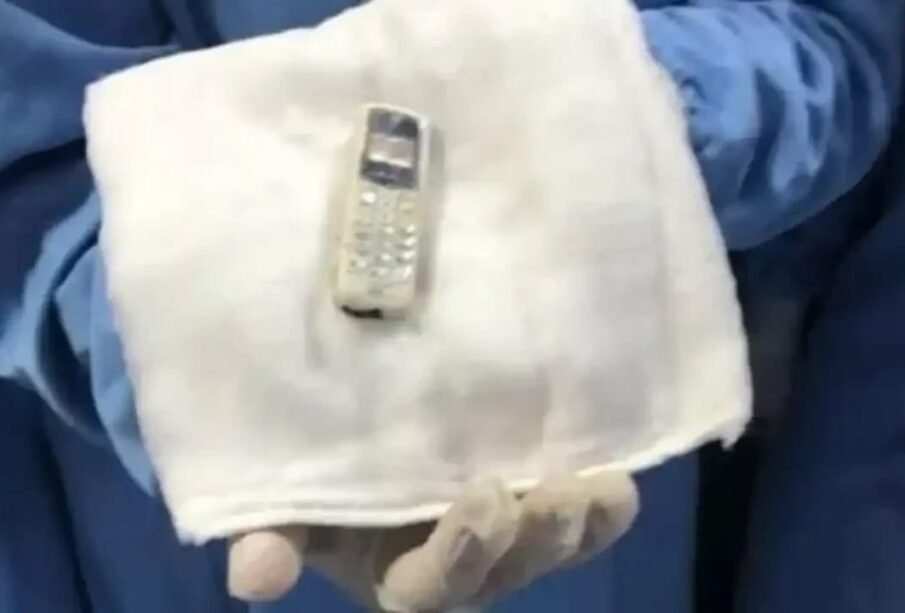 چھ سال بعدموبائل فون کومریض کےپیٹ سےنکال لیاگیا