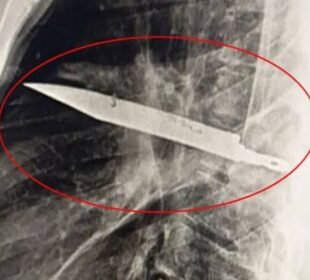 شہری کے سینے سے 8 سال بعد چاقو نکال لیا گیا