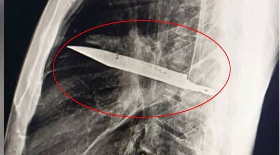 شہری کے سینے سے 8 سال بعد چاقو نکال لیا گیا