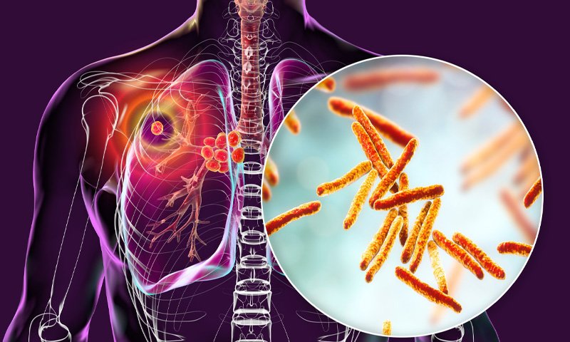 "دنیا کے آٹھ ممالک میں پھیلی خطرناک وبا — فہرست میں پاکستان بھی شامل!"