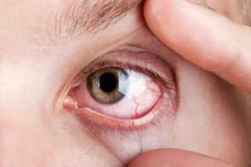 ہائی بلڈ پریشر صرف دل کے لیے نہیں، آنکھوں کے لیے بھی خطرہ