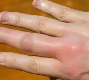 سردیوں میں ہاتھ اور پیر کیوں سوج جاتے ہیں؟ 7 سردیوں میں ہاتھ اور پیر کیوں سوج جاتے ہیں؟