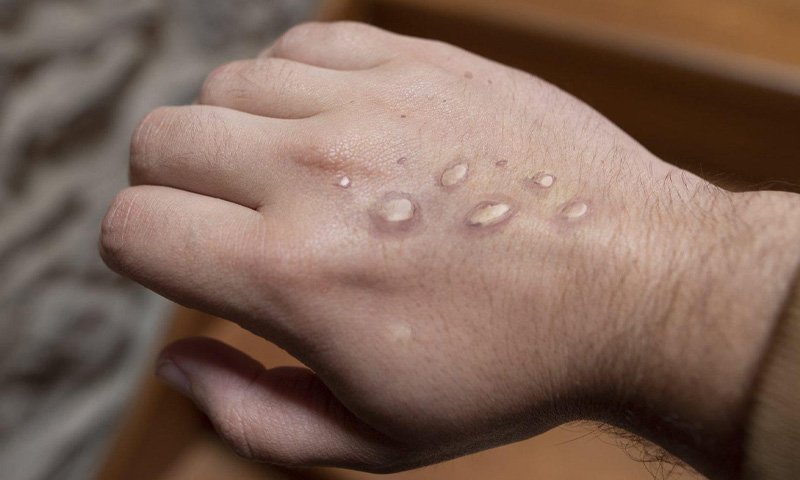 لاہور: منکی پاکس کے نئے کیسز رپورٹ، صحت کے حکام نے الرٹ جاری کر دیا