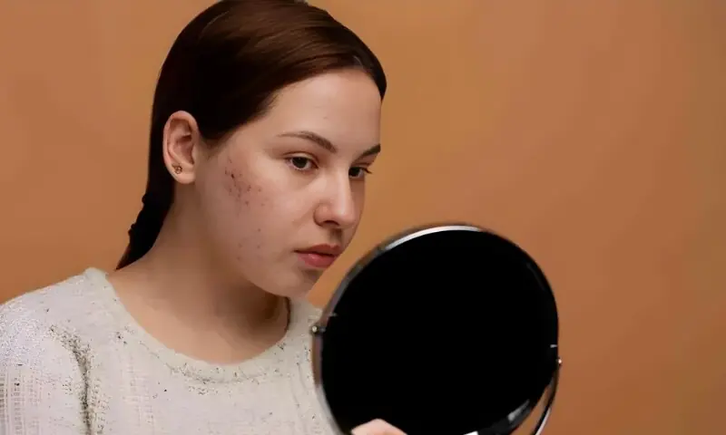 سردیوں میں جلدی مسائل اور کیل مہاسوں کا بڑھنا: وجوہات اور حل