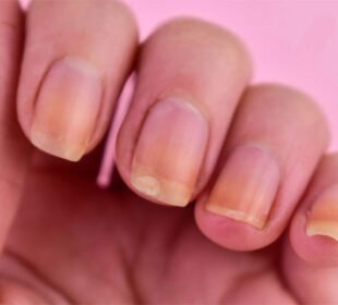 ناخنوں کے رنگ میں تبدیلی: صحت سے جڑی اہم علامات