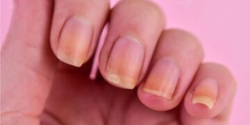 ناخنوں کے رنگ میں تبدیلی: صحت سے جڑی اہم علامات