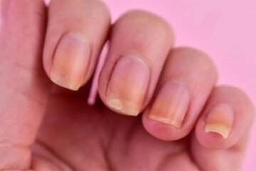ناخنوں کے رنگ میں تبدیلی: صحت سے جڑی اہم علامات 3 ناخنوں کے رنگ میں تبدیلی: صحت سے جڑی اہم علامات