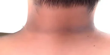 گردن پر سیاہ نشان: محض جلد کا مسئلہ نہیں، صحت کا اہم اشارہ