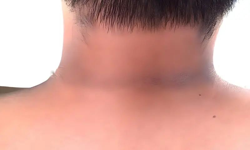گردن پر سیاہ نشان: محض جلد کا مسئلہ نہیں، صحت کا اہم اشارہ