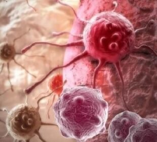 روبوٹک سرجری کے ذریعے لبلبے کے کینسر کا کامیاب آپریشن 2 روبوٹک سرجری کے ذریعے لبلبے کے کینسر کا کامیاب آپریشن