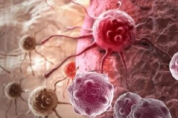 روبوٹک سرجری کے ذریعے لبلبے کے کینسر کا کامیاب آپریشن