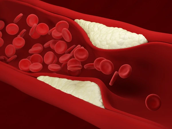 atherosclerosisشریانوں میں چکنائی سے بچاؤ کے آسان طریقے-41770457626-0-600x450