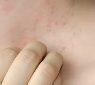 گرمیوں میں عام مسئلہ: گرمی دانے اور بچاؤ کے آسان طریقے