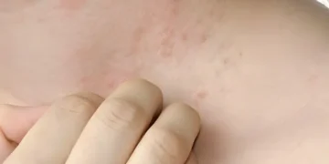 گرمیوں میں عام مسئلہ: گرمی دانے اور بچاؤ کے آسان طریقے