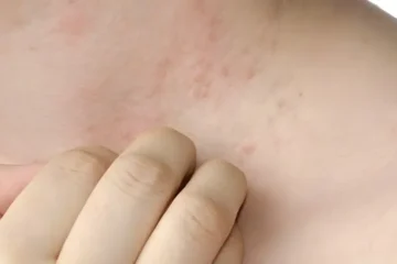 گرمیوں میں عام مسئلہ: گرمی دانے اور بچاؤ کے آسان طریقے 2 گرمیوں میں عام مسئلہ: گرمی دانے اور بچاؤ کے آسان طریقے