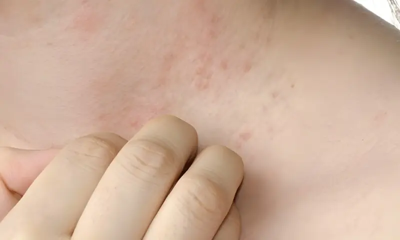 گرمیوں میں عام مسئلہ: گرمی دانے اور بچاؤ کے آسان طریقے