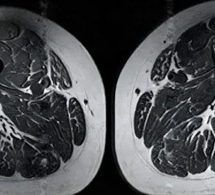 الٹرا پروسیسڈ غذاؤں کے پٹھوں اور مجموعی صحت پر سنگین اثرات