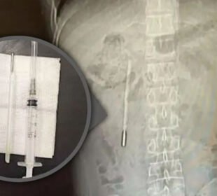 چینی شہری کے پیٹ سے بچپن میں نگلا گیا تھرمامیٹر 20 سال بعد نکال لیا گیا