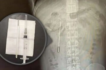 چینی شہری کے پیٹ سے بچپن میں نگلا گیا تھرمامیٹر 20 سال بعد نکال لیا گیا