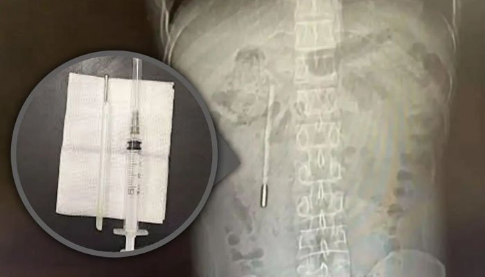 431897_67086چینی شہری کے پیٹ سے بچپن میں نگلا گیا تھرمامیٹر 20 سال بعد نکال لیا گیا88_updates