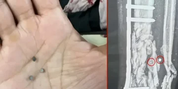 لبنان اور غزہ میں مبینہ مہلک دھاتی ذرات والے ہتھیاروں کے استعمال کا انکشاف 32 لبنان اور غزہ میں مبینہ مہلک دھاتی ذرات والے ہتھیاروں کے استعمال کا انکشاف