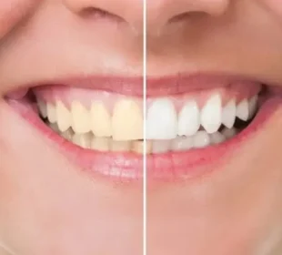 دانتوں کی سفیدی کے لیے گھریلو ٹوٹکے نقصان دہ ثابت ہوسکتے ہیں