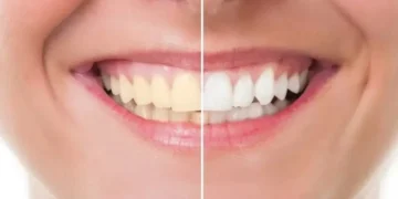 دانتوں کی سفیدی کے لیے گھریلو ٹوٹکے نقصان دہ ثابت ہوسکتے ہیں 8 دانتوں کی سفیدی کے لیے گھریلو ٹوٹکے نقصان دہ ثابت ہوسکتے ہیں