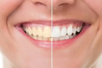 دانتوں کی سفیدی کے لیے گھریلو ٹوٹکے نقصان دہ ثابت ہوسکتے ہیں