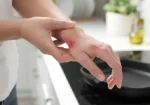جلنے کی صورت میں فوری کیا کریں؟ ماہرین نے عام گھریلو ٹوٹکوں سے خبردار کردیا