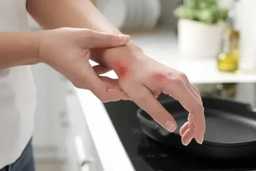 جلنے کی صورت میں فوری کیا کریں؟ ماہرین نے عام گھریلو ٹوٹکوں سے خبردار کردیا 2 جلنے کی صورت میں فوری کیا کریں؟ ماہرین نے عام گھریلو ٹوٹکوں سے خبردار کردیا