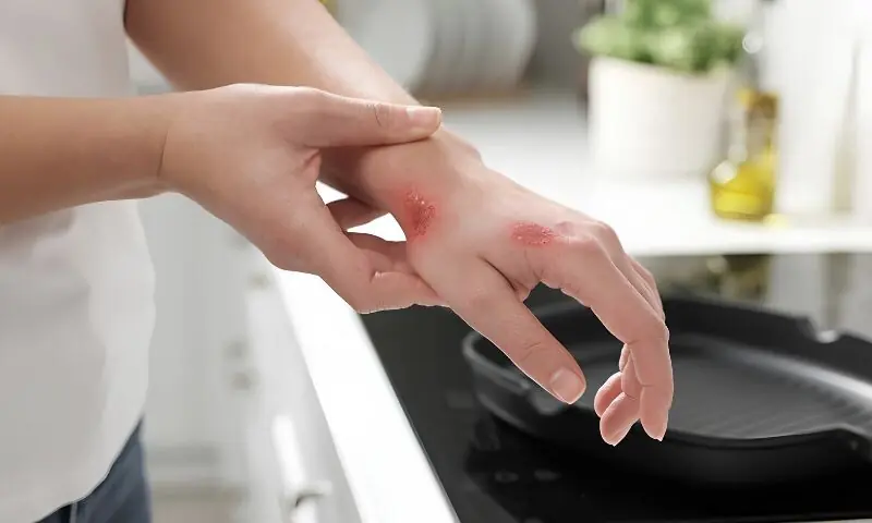 جلنے کی صورت میں فوری کیا کریں؟ ماہرین نے عام گھریلو ٹوٹکوں سے خبردار کردیا